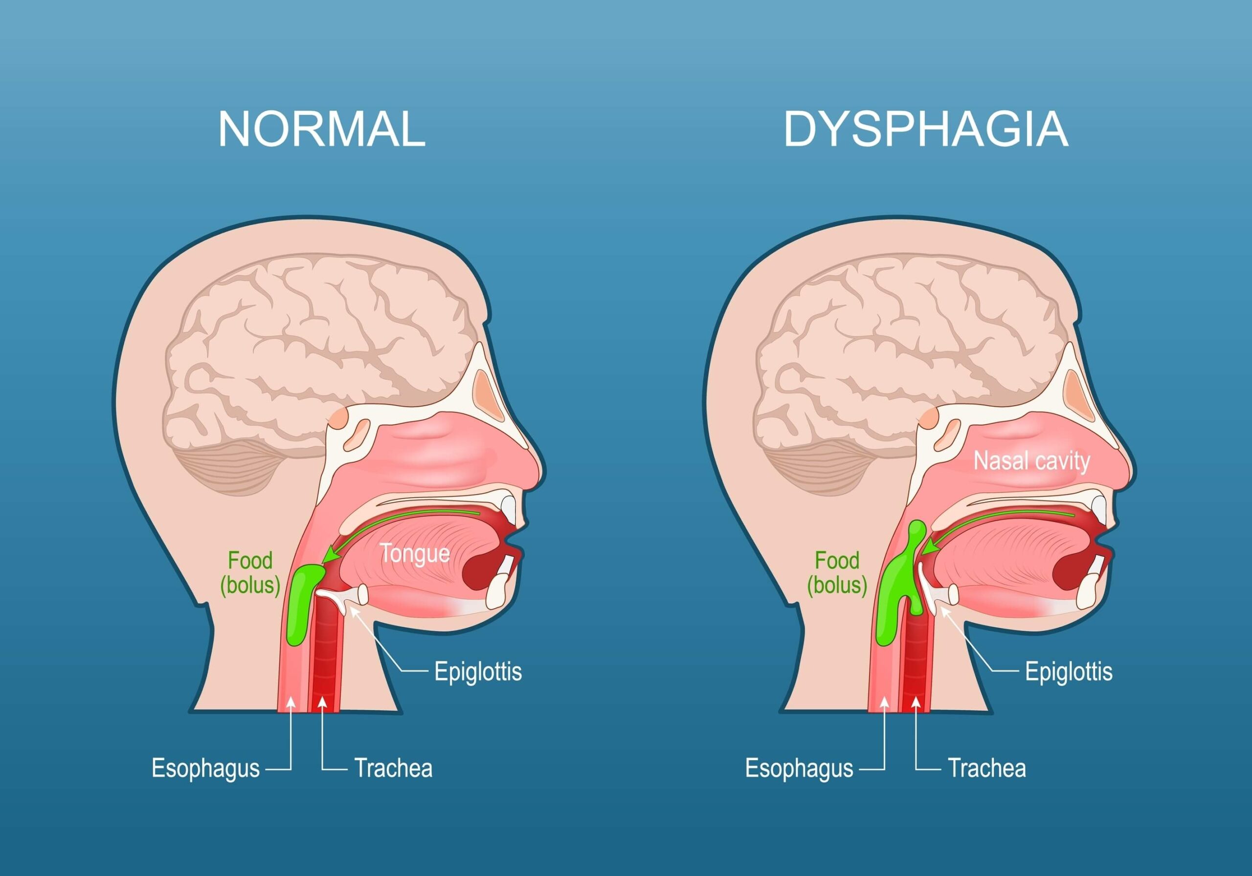 Trouble Swallowing